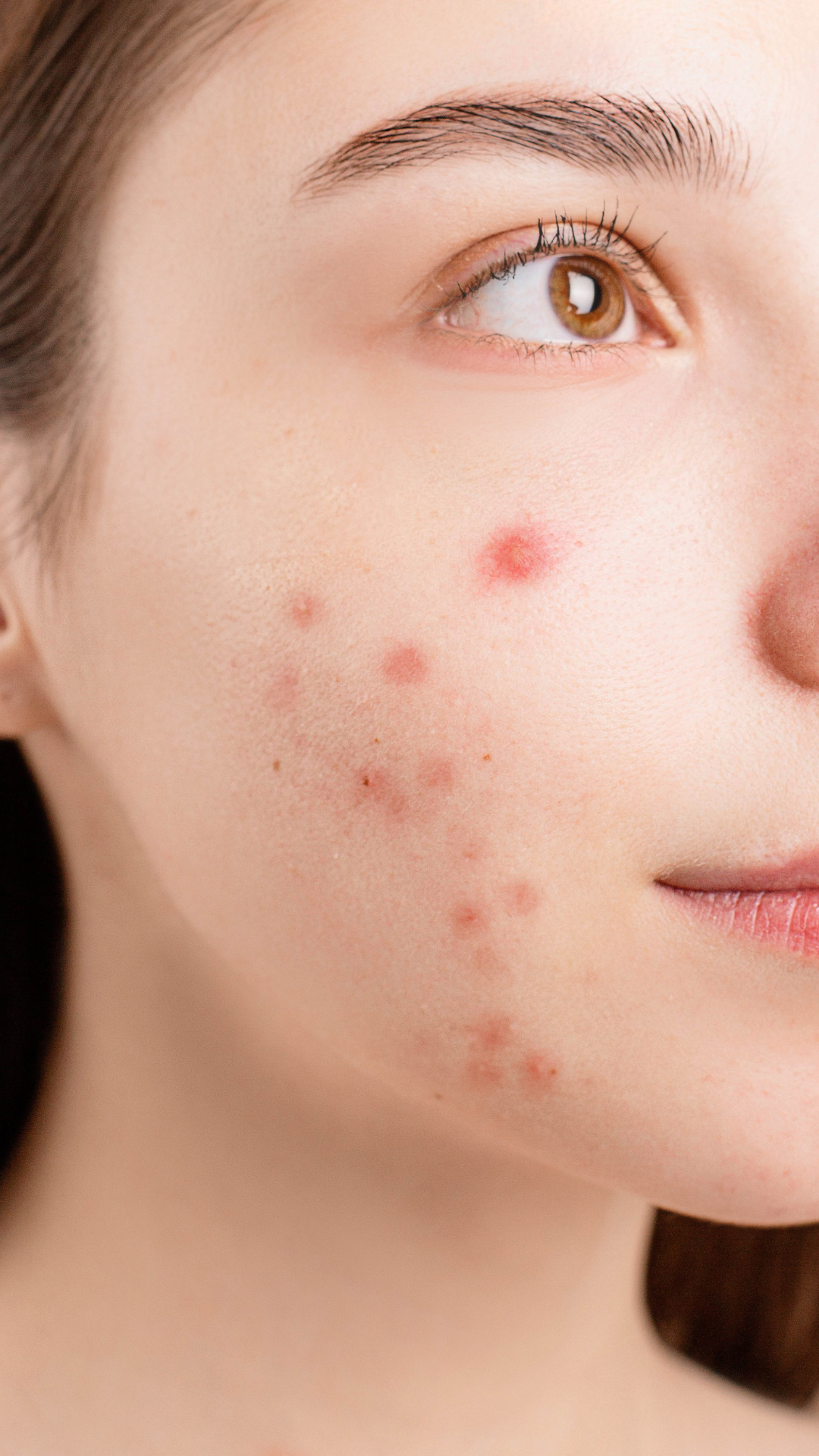Acne Marks